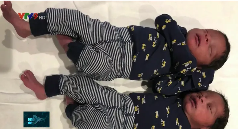 Hy hữu người phụ nữ sinh đôi 2 lần trong 1 năm - Ảnh 1.