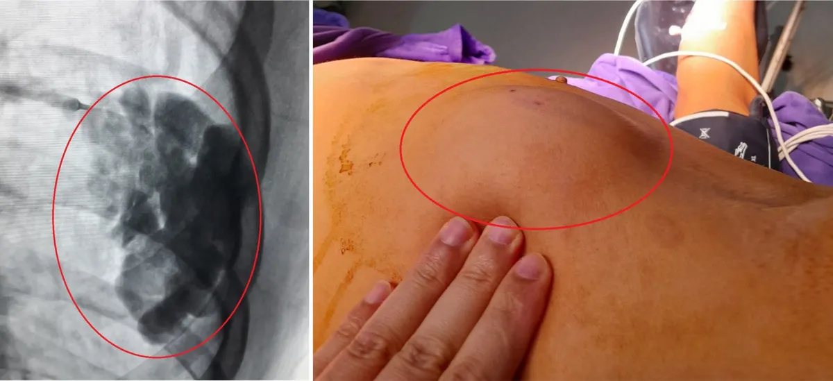 Loại bỏ khối dị dạng mạch máu gây đau tức ngực - Ảnh 1. Loại bỏ khối dị dạng mạch máu gây đau tức ngực - Ảnh 1.