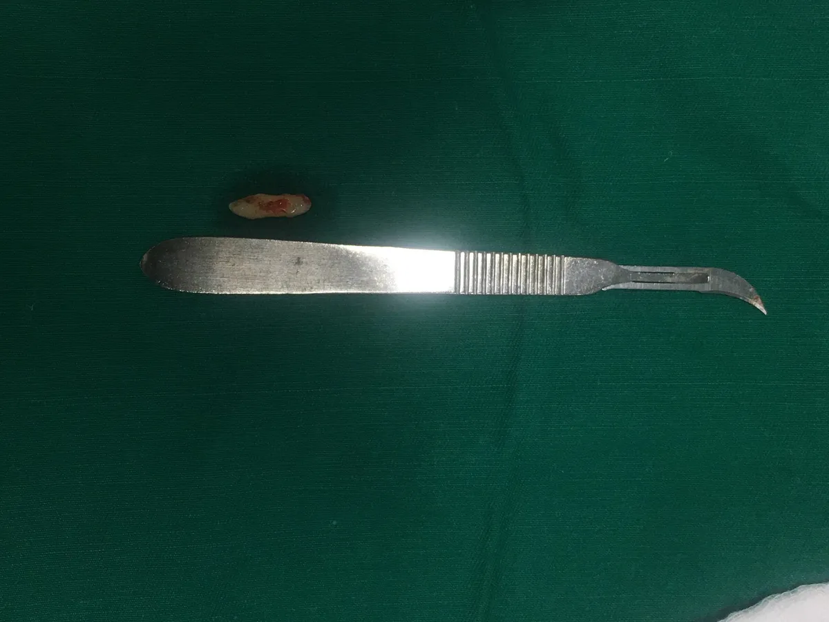 Vào viện phát hiện răng ngầm xương hàm chọc thủng hốc mũi, phá hủy xương hàm - Ảnh 1.