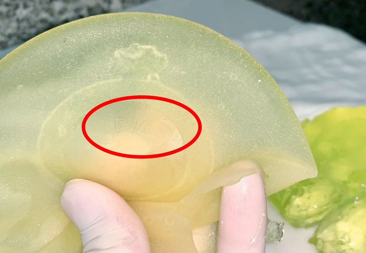 Vỡ túi ngực, silicon dính chặt các mô, tuyến ngực một phụ nữ - Ảnh 1. Vỡ túi ngực, silicon dính chặt các mô, tuyến ngực một phụ nữ - Ảnh 1.