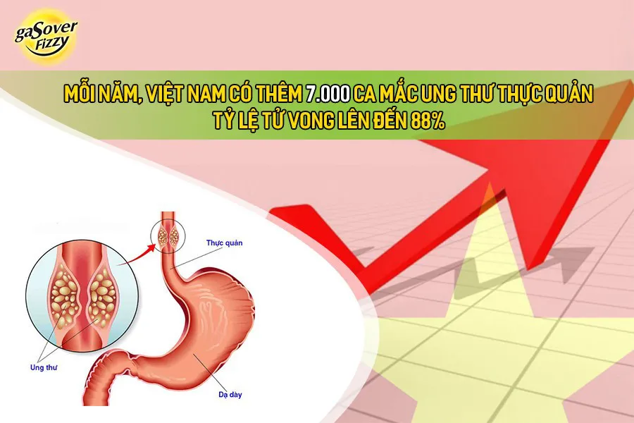 Trào ngược dạ dày có thể dẫn đến ung thư thực quản – GasOver Fizzy từ hôm nay! - Ảnh 1. Trào ngược dạ dày có thể dẫn đến ung thư thực quản – GasOver Fizzy từ hôm nay! - Ảnh 1.