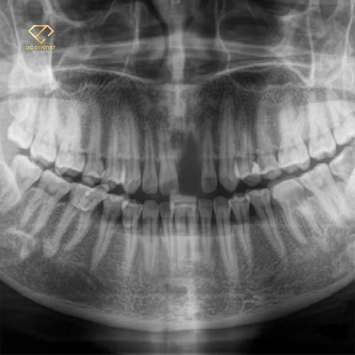 Hành trình tìm lại nụ cười tự tin bằng phương pháp phục hình Implant và bọc sứ Emax - Ảnh 3.