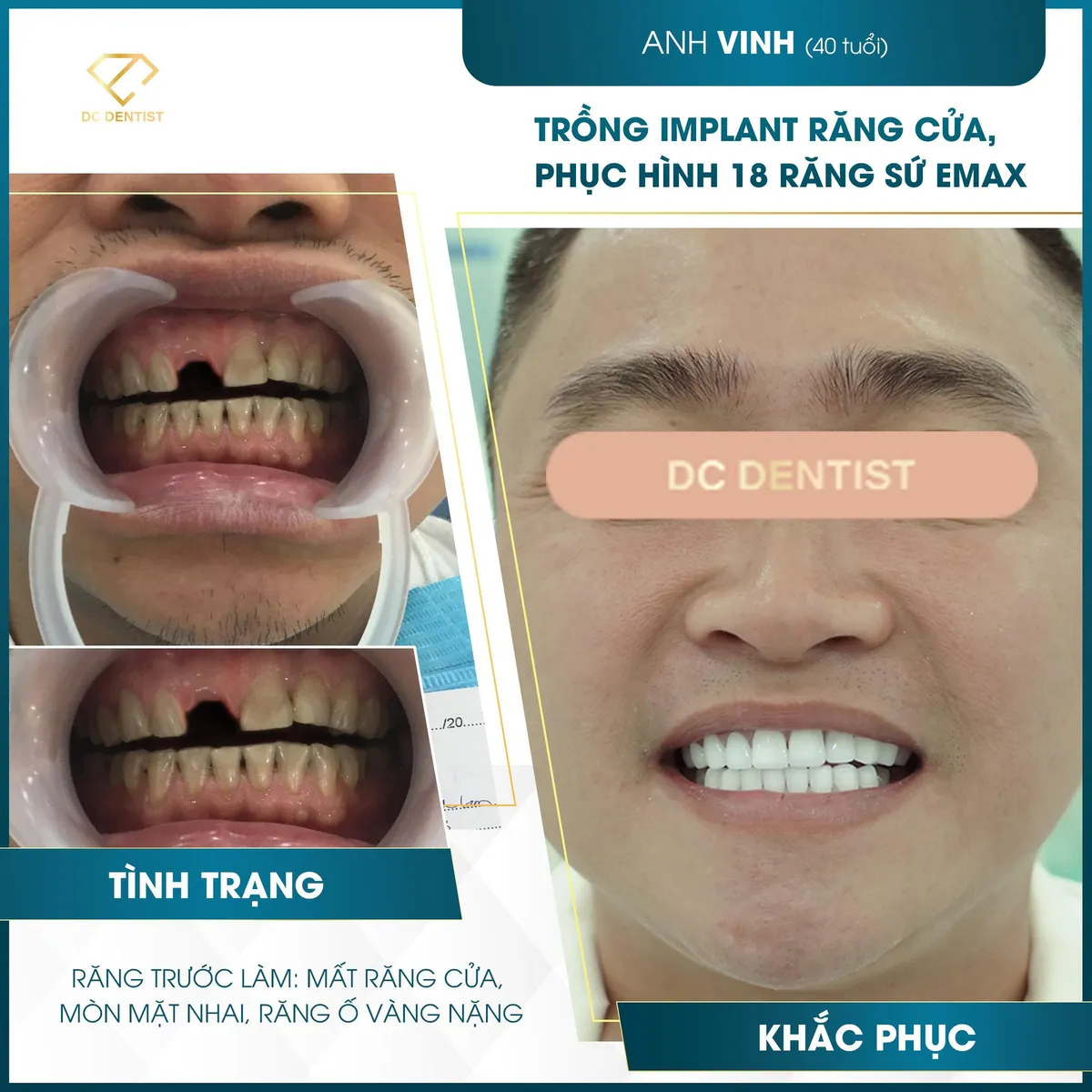 Hành trình tìm lại nụ cười tự tin bằng phương pháp phục hình Implant và bọc sứ Emax - Ảnh 4.