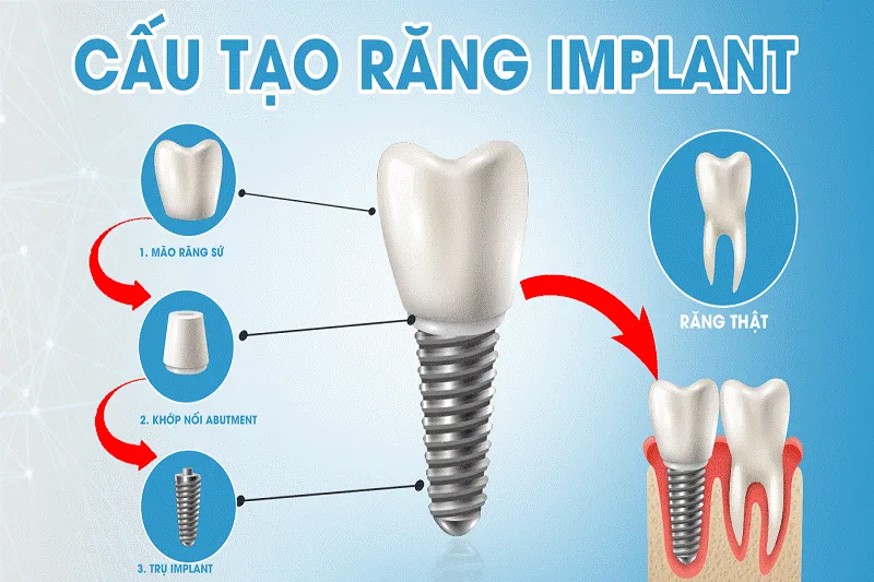 Chọn phương pháp trồng răng giả giá rẻ có an toàn hay không? - Ảnh 2.