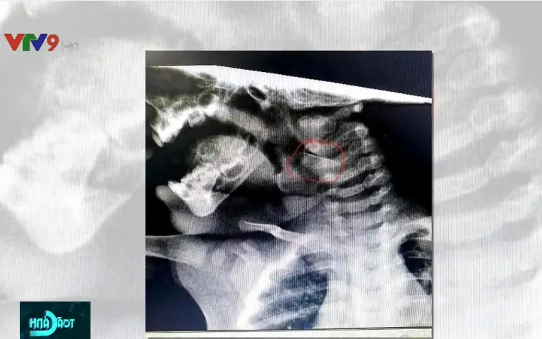 Bé gái 8 tháng tuổi nuốt mảnh thủy tinh từ ống thuốc vỡ - Ảnh 2. Bé gái 8 tháng tuổi nuốt mảnh thủy tinh từ ống thuốc vỡ - Ảnh 2.