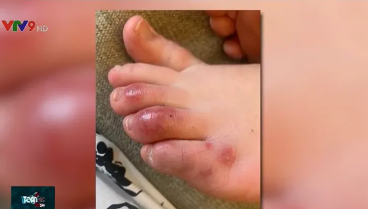 “Ngón chân Covid”: Triệu chứng lạ ở bệnh nhân nhiễm virus SARS-CoV-2 - Ảnh 1. “Ngón chân Covid”: Triệu chứng lạ ở bệnh nhân nhiễm virus SARS-CoV-2 - Ảnh 1.