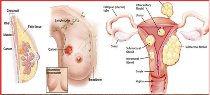 TPBVSK Tiêu Mộc Vương – hỗ trợ giảm sự phát triển của u xơ ở phụ nữ - Ảnh 1.