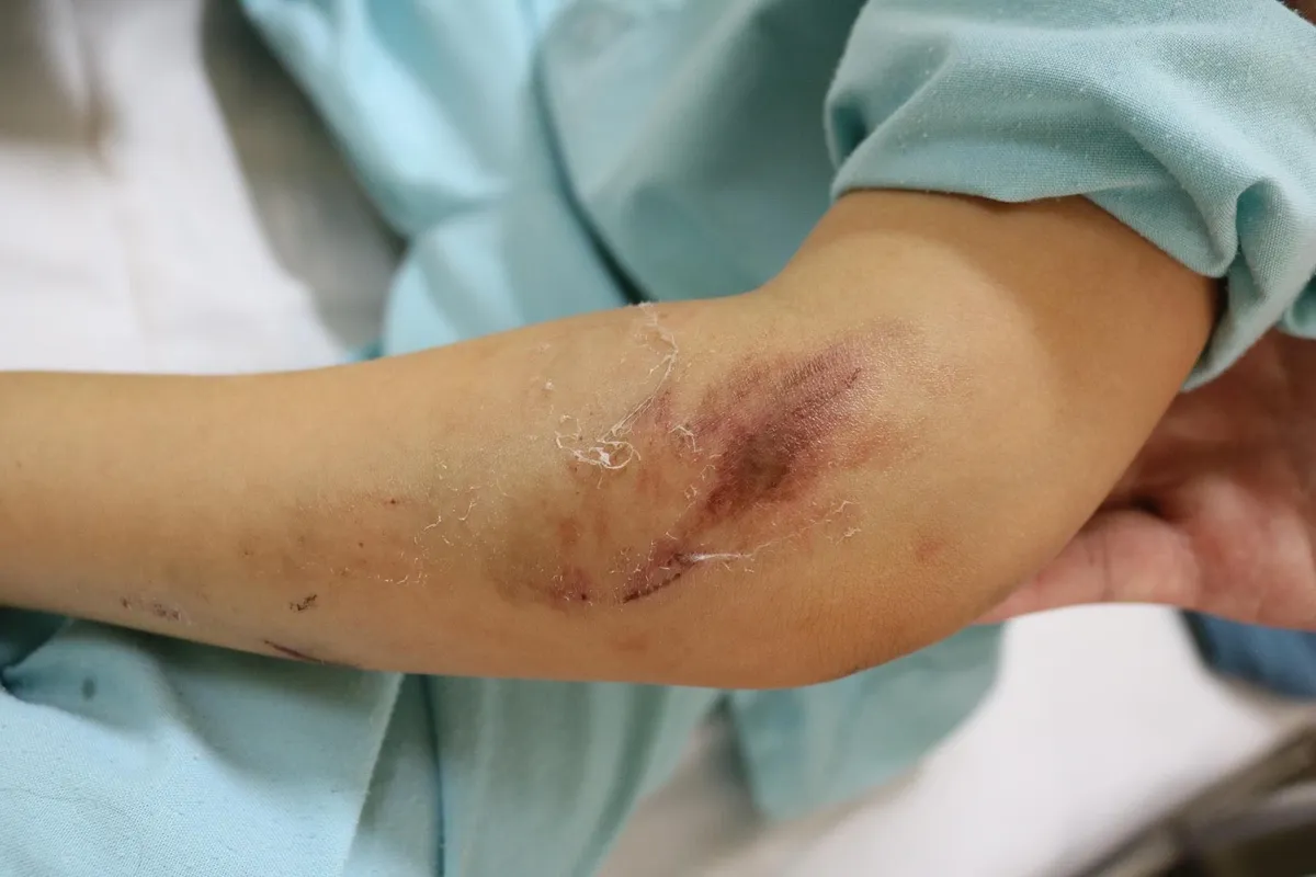 Khoác áo chống nắng của mẹ, bé gái bị... cuốn vào bánh xe máy - Ảnh 1.