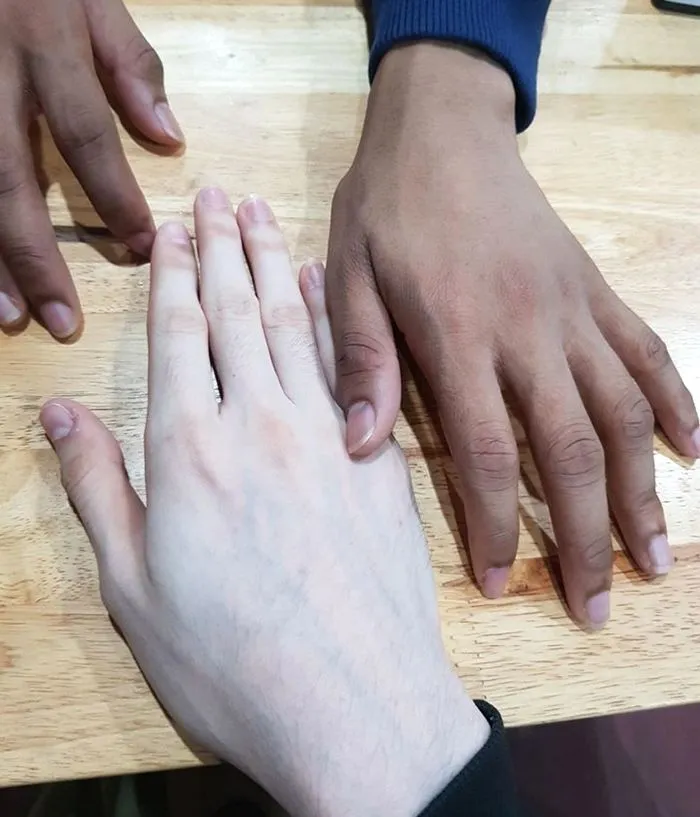 Da trắng như mắc bệnh bạch tạng vì sử dụng kem làm trắng - Ảnh 1. Da trắng như mắc bệnh bạch tạng vì sử dụng kem làm trắng - Ảnh 1.