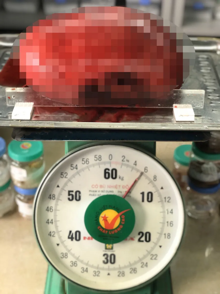Ngỡ béo bụng, người phụ nữ không ngờ mang khối u nặng gần 6kg - Ảnh 1. Ngỡ béo bụng, người phụ nữ không ngờ mang khối u nặng gần 6kg - Ảnh 1.