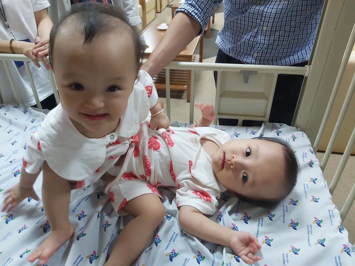 93 nhân viên y tế sẵn sàng cho ca mổ tách dính phức tạp đầu tiên tại Bệnh viện Nhi đồng Thành phố - Ảnh 2. 93 nhân viên y tế sẵn sàng cho ca mổ tách dính phức tạp đầu tiên tại Bệnh viện Nhi đồng Thành phố - Ảnh 2.
