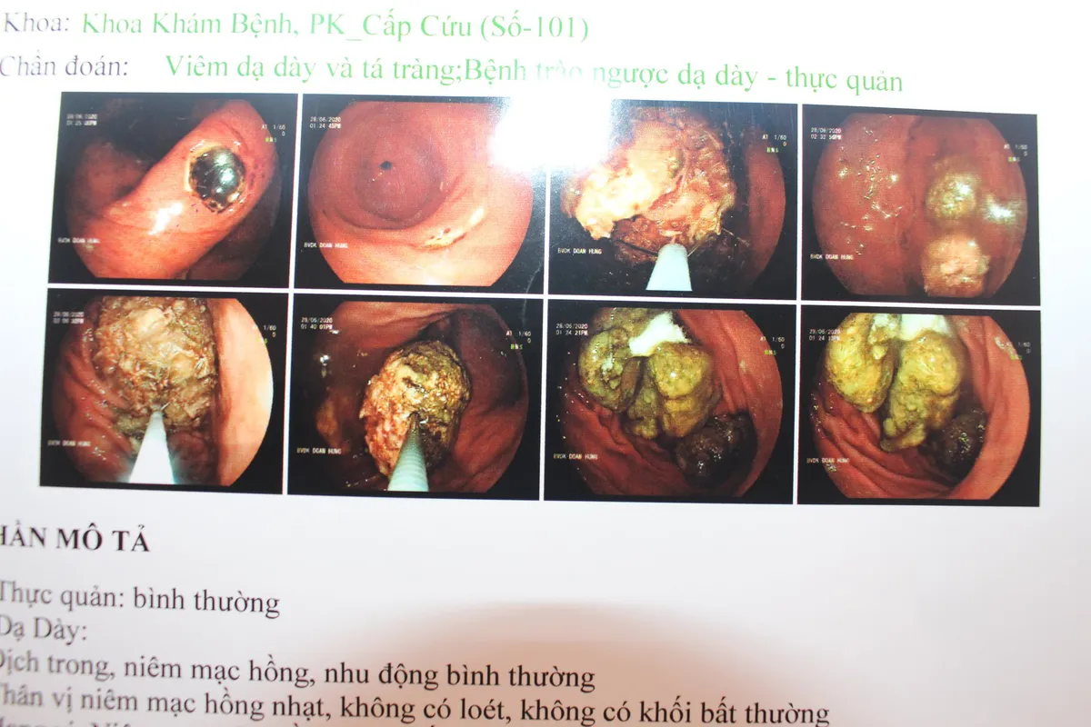 Loét dạ dày, xuất huyết tiêu hóa sau khi ăn quả bứa, uống trà sữa trân châu - Ảnh 1.