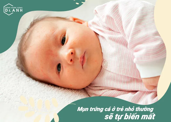 Top 5 nguy&ecirc;n nh&acirc;n h&agrave;ng đầu khiến trẻ sơ sinh bị nổi mẩn đỏ - Ảnh 1.