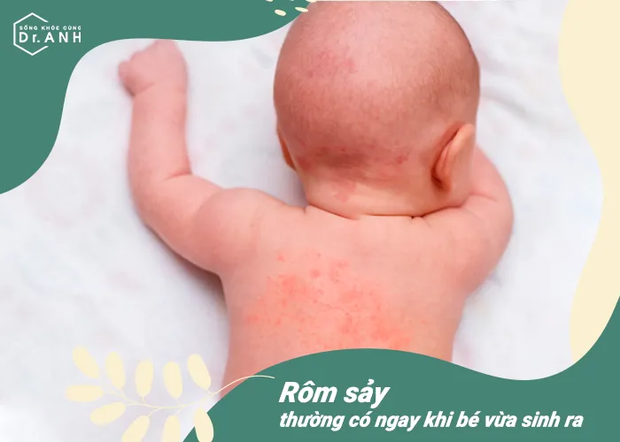Top 5 nguy&ecirc;n nh&acirc;n h&agrave;ng đầu khiến trẻ sơ sinh bị nổi mẩn đỏ - Ảnh 2.