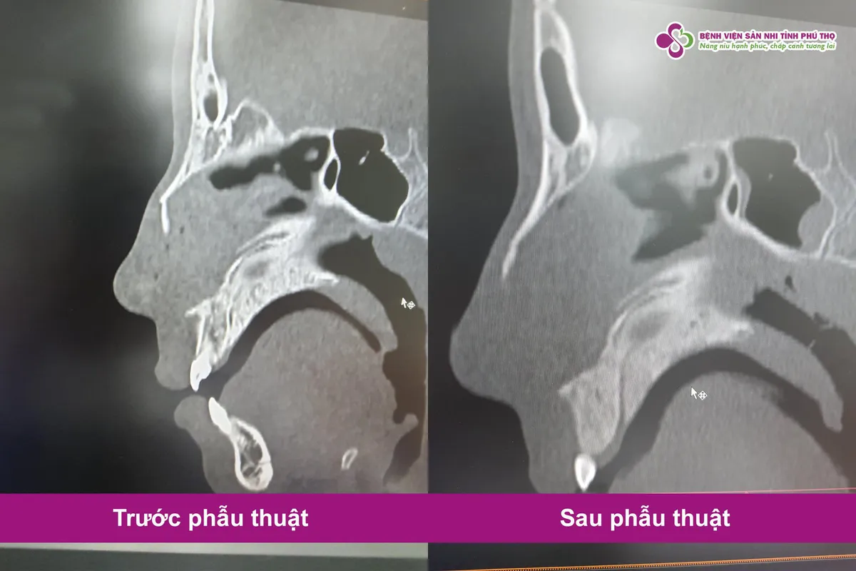 Ngã xe đạp trên đường đi học, nam sinh 14 tuổi bị gãy xương mũi, chấn thương vùng hàm mặt - Ảnh 1. Ngã xe đạp trên đường đi học, nam sinh 14 tuổi bị gãy xương mũi, chấn thương vùng hàm mặt - Ảnh 1.