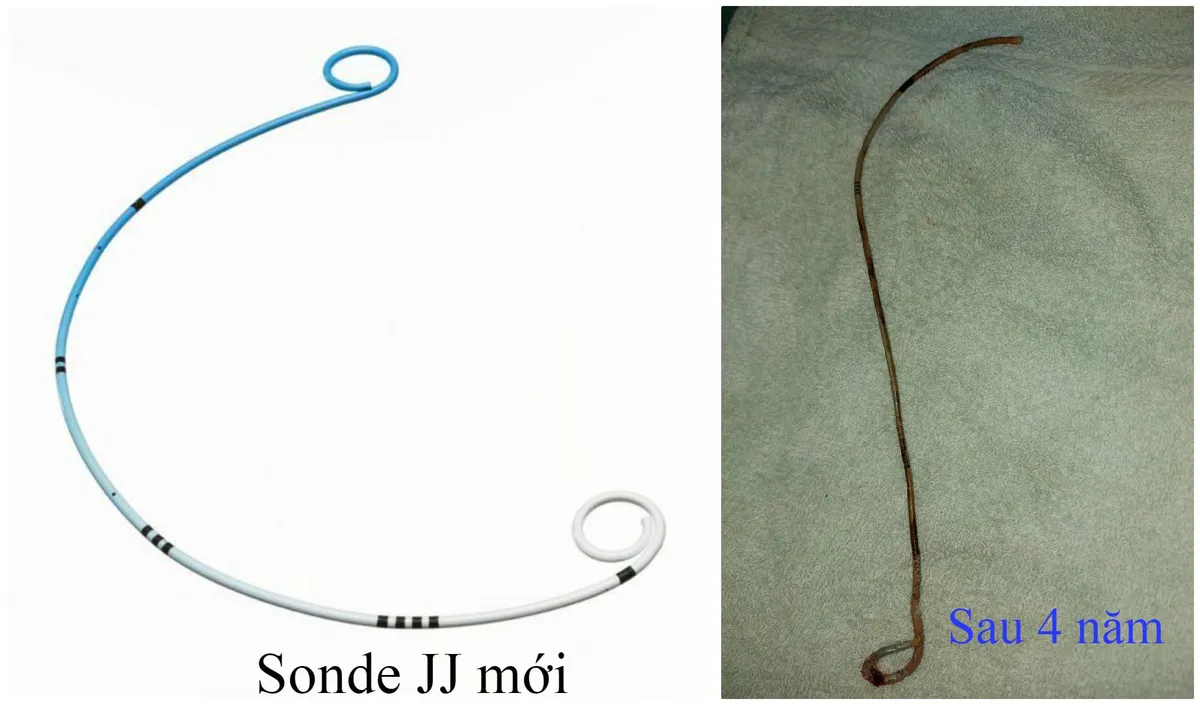Sỏi to như quả trứng gà tích tụ quanh ống sonde JJ bỏ quên suốt... 4 năm trong bụng - Ảnh 1.