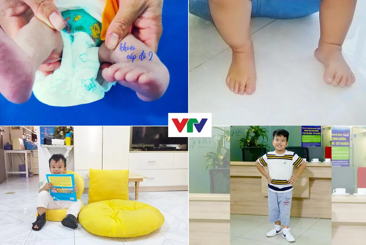 Cảm động b&eacute; 6 tuổi bị &ldquo;kho&egrave;o ch&acirc;n&rdquo; ki&ecirc;n tr&igrave; điều trị để đi lại b&igrave;nh thường - Ảnh 2.