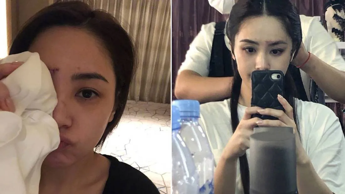 Chung Hân Đồng khoe vết sẹo dài ngoằng trên trán, khán giả e ngại - Ảnh 2.
