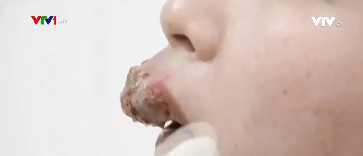 Phẫu thuật làm đẹp đón Tết, nhiều chị em chịu hậu quả nặng nề - Ảnh 1.