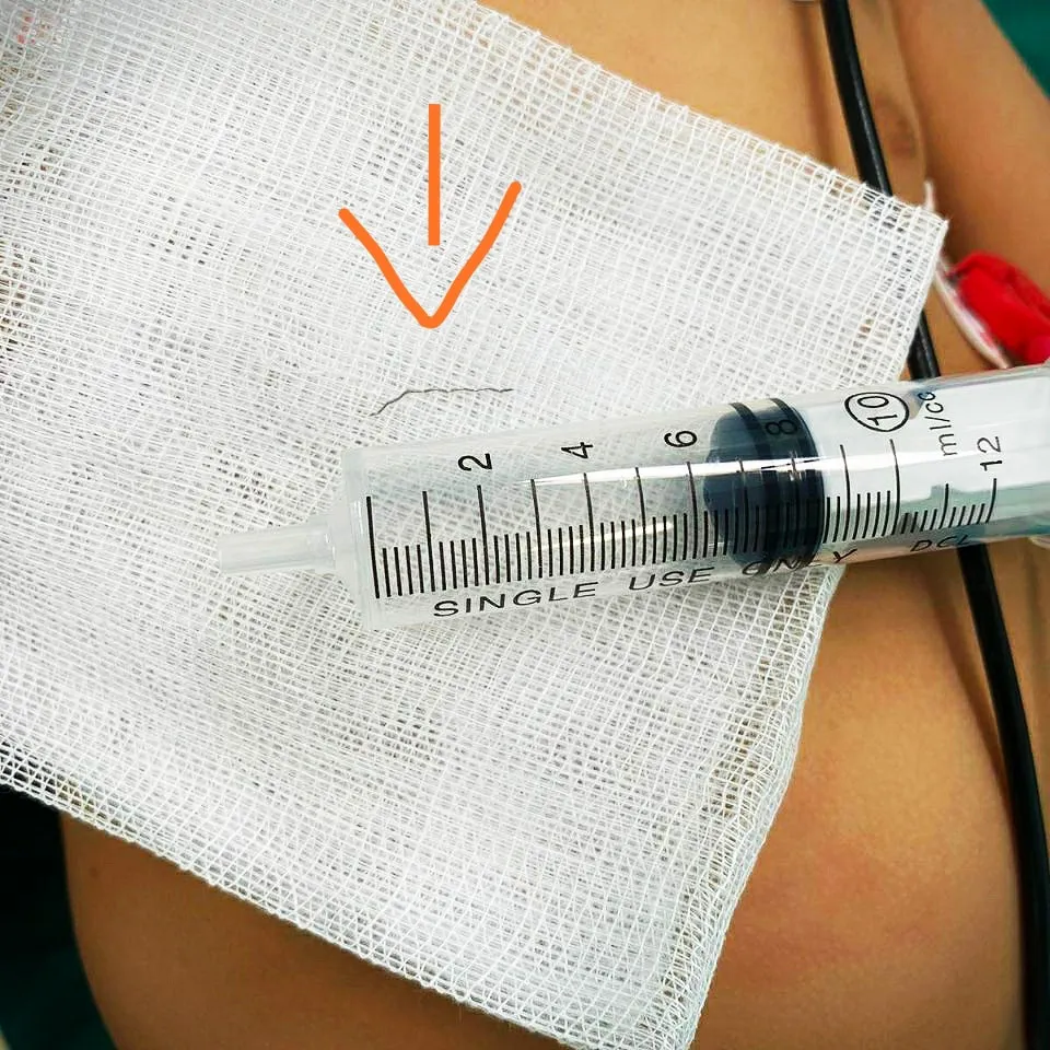Đang ăn dặm thì quấy khóc liên tục, vào viện bác sĩ tìm ra thủ phạm ít ai ngờ - Ảnh 2. Đang ăn dặm thì quấy khóc liên tục, vào viện bác sĩ tìm ra thủ phạm ít ai ngờ - Ảnh 2.