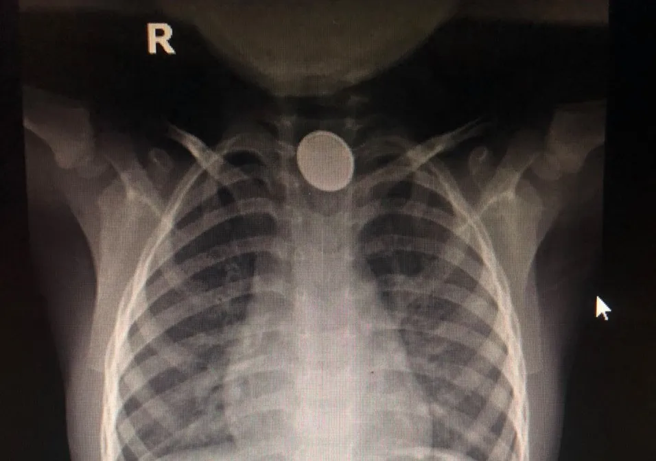 Bé 4 tuổi bỏng thực quản do nuốt pin rỉ sét - Ảnh 1. Bé 4 tuổi bỏng thực quản do nuốt pin rỉ sét - Ảnh 1.