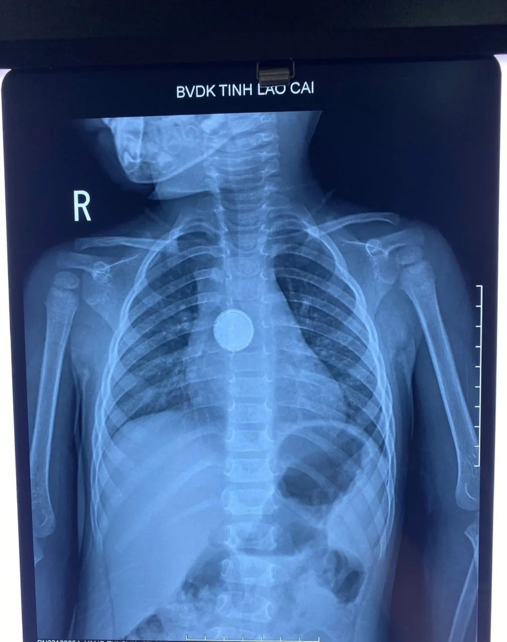 Bé 3 tuổi nhập viện vì pin cúc áo mắc kẹt ở thực quản - Ảnh 1. Bé 3 tuổi nhập viện vì pin cúc áo mắc kẹt ở thực quản - Ảnh 1.