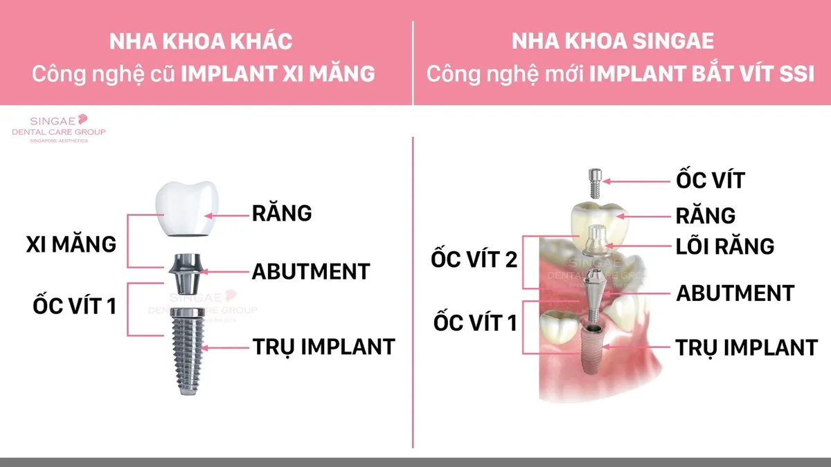 Nha khoa Singae – Địa chỉ uy tín để có hàm răng khỏe, đẹp - Ảnh 4.