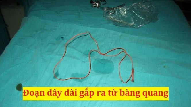 Bác sĩ rút ra từ niệu đạo bé trai thỏi nam châm, kẹp giấy - Ảnh 1. Bác sĩ rút ra từ niệu đạo bé trai thỏi nam châm, kẹp giấy - Ảnh 1.