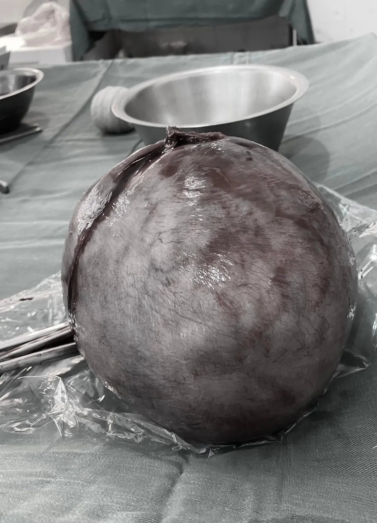 Thấy bụng to bất thường, vào viện phát hiện khối u xơ nặng gần 3kg - Ảnh 1. Thấy bụng to bất thường, vào viện phát hiện khối u xơ nặng gần 3kg - Ảnh 1.