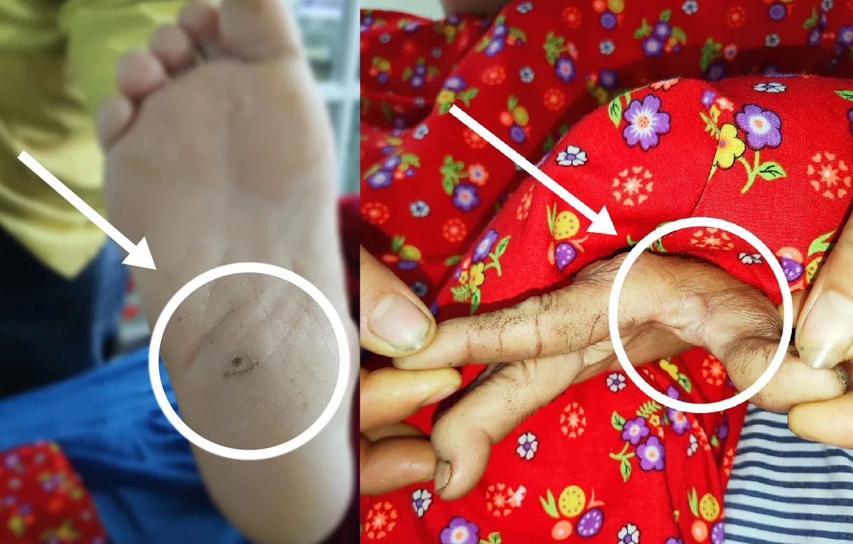 Liên tiếp tiếp nhận 2 ca uốn ván - cứng hàm - Ảnh 1. Liên tiếp tiếp nhận 2 ca uốn ván - cứng hàm - Ảnh 1.