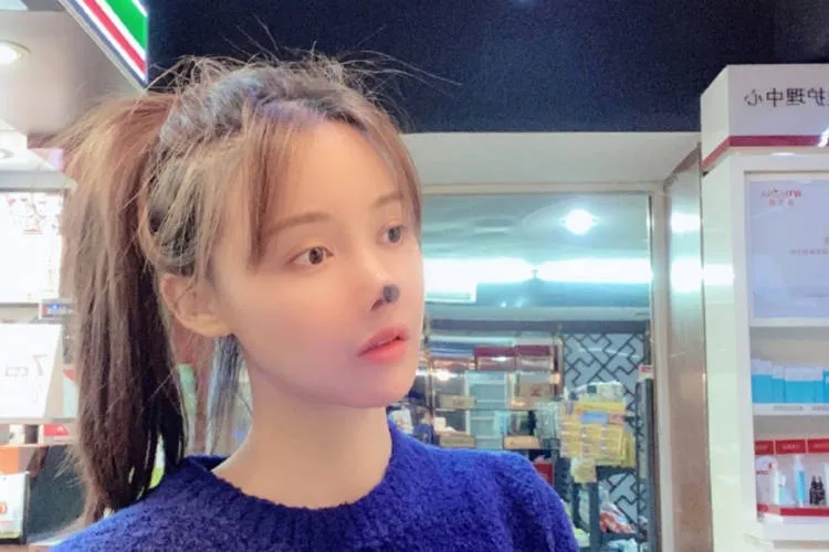 Hoại tử mũi vì phẫu thuật thẩm mỹ - Ảnh 1. Hoại tử mũi vì phẫu thuật thẩm mỹ - Ảnh 1.