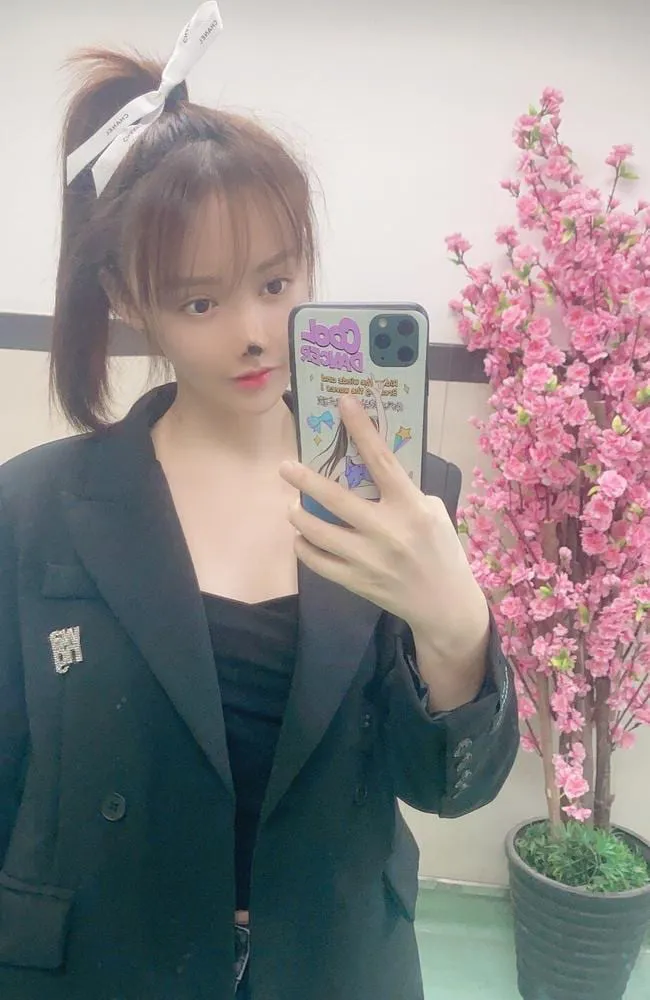 Hoại tử mũi vì phẫu thuật thẩm mỹ - Ảnh 2. Hoại tử mũi vì phẫu thuật thẩm mỹ - Ảnh 2.