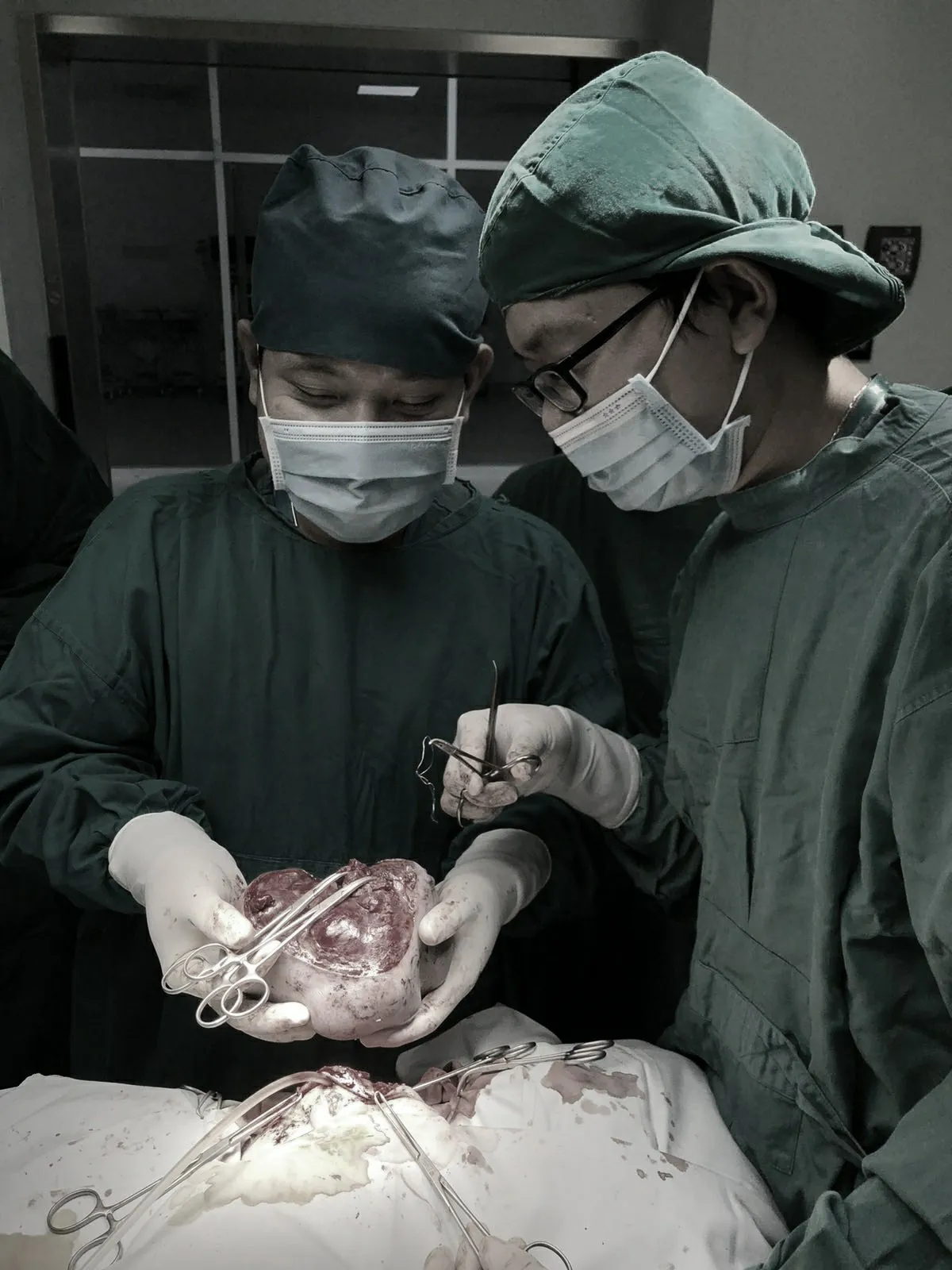Bé sơ sinh chào đời với khối u quái khổng lồ vùng cụt - Ảnh 1.