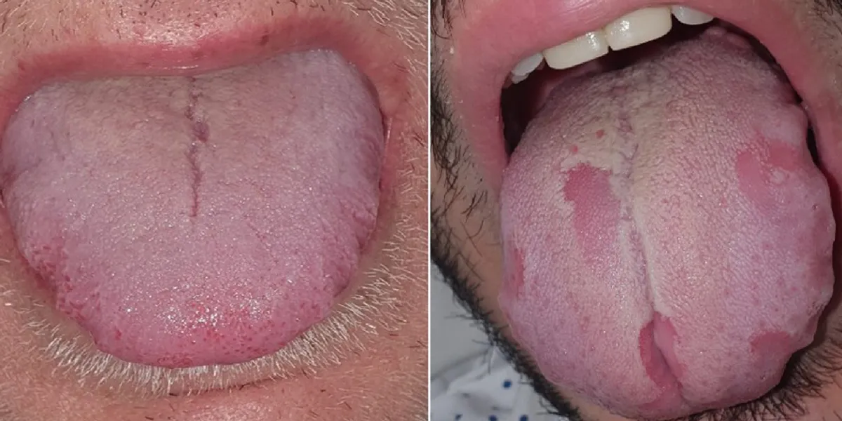 COVID lưỡi - triệu chứng mới đáng ngại của đại dịch - Ảnh 1.