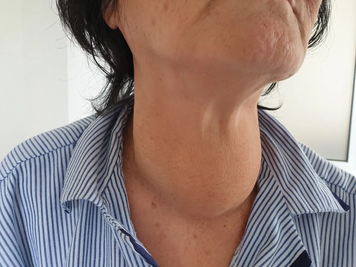 Bóc tách khối bướu giáp kích thước lớn cho 3 bệnh nhân nữ ở Tây Ninh - Ảnh 1.