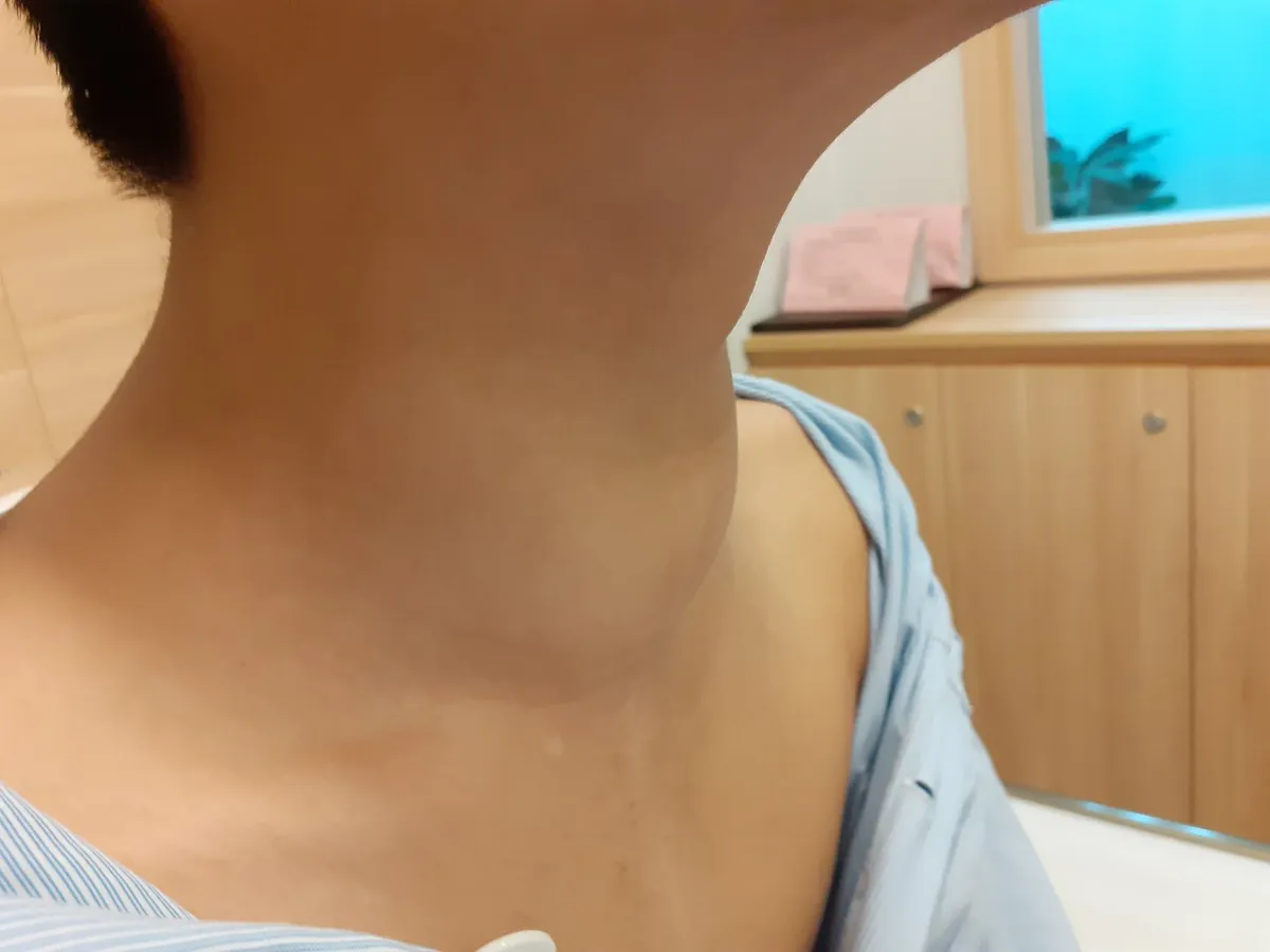 5 năm xin về điều trị thuốc nam, bé trai nhập viện vì u giáp di căn phổi - Ảnh 1.