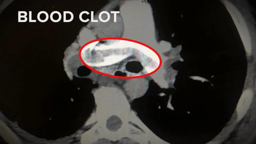 Nguy cơ đông máu do mắc COVID-19 cao hơn tiêm vaccine - Ảnh 1. Nguy cơ đông máu do mắc COVID-19 cao hơn tiêm vaccine - Ảnh 1.