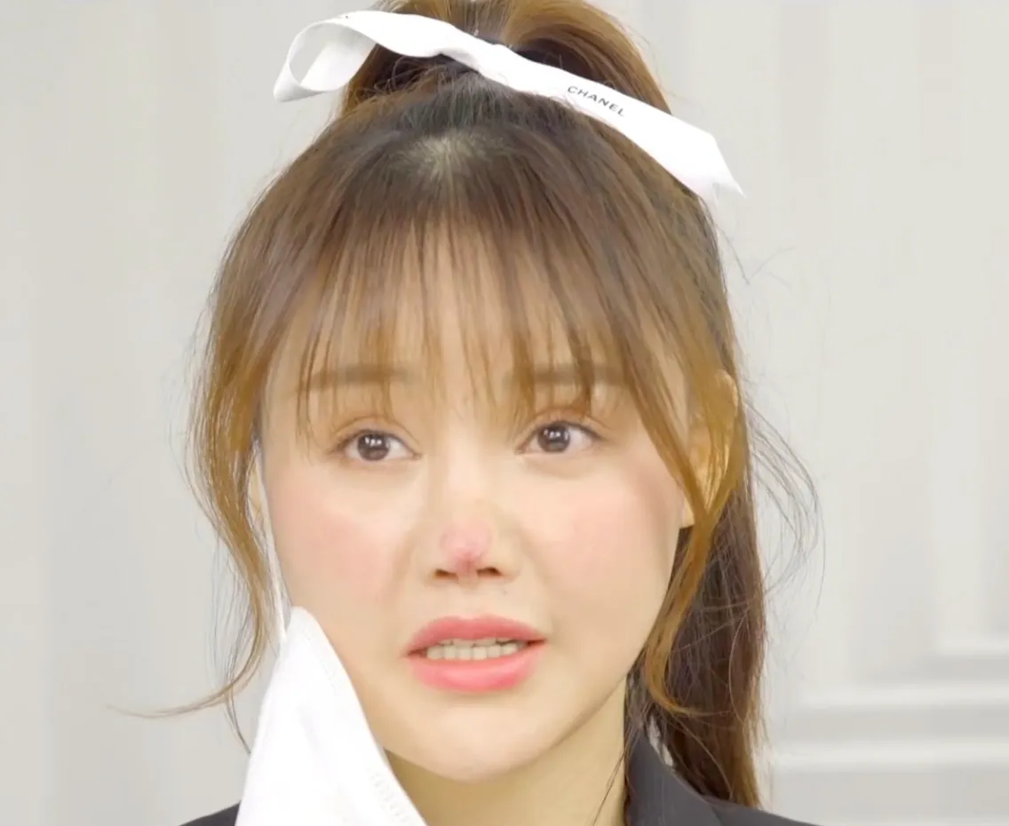 Nữ diễn vi&ecirc;n Trung Quốc bị hoại tử mũi do phẫu thuật khuy&ecirc;n c&aacute;c c&ocirc; g&aacute;i cẩn thận khi l&agrave;m đẹp - Ảnh 2.