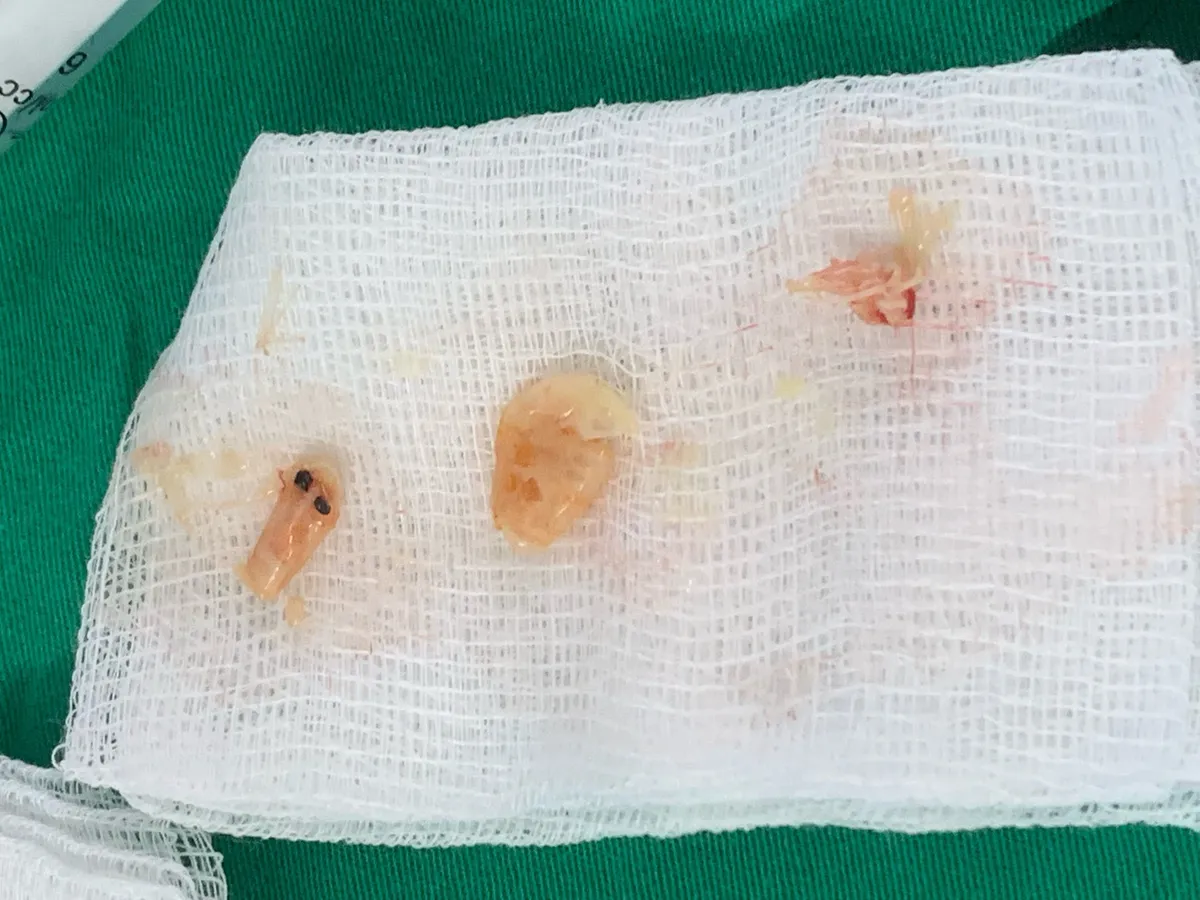 Cảnh báo dị vật đường thở ở trẻ em - Ảnh 1. Cảnh báo dị vật đường thở ở trẻ em - Ảnh 1.