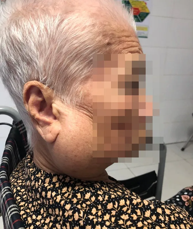 Phẫu thuật khối u tuyến mang tai kích thước lớn ở bệnh nhân cao tuổi - Ảnh 1. Phẫu thuật khối u tuyến mang tai kích thước lớn ở bệnh nhân cao tuổi - Ảnh 1.