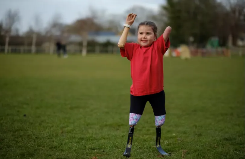 Em b&eacute; 8 tuổi được lắp chi giả điều khiển bằng m&aacute;y t&iacute;nh - Ảnh 1.