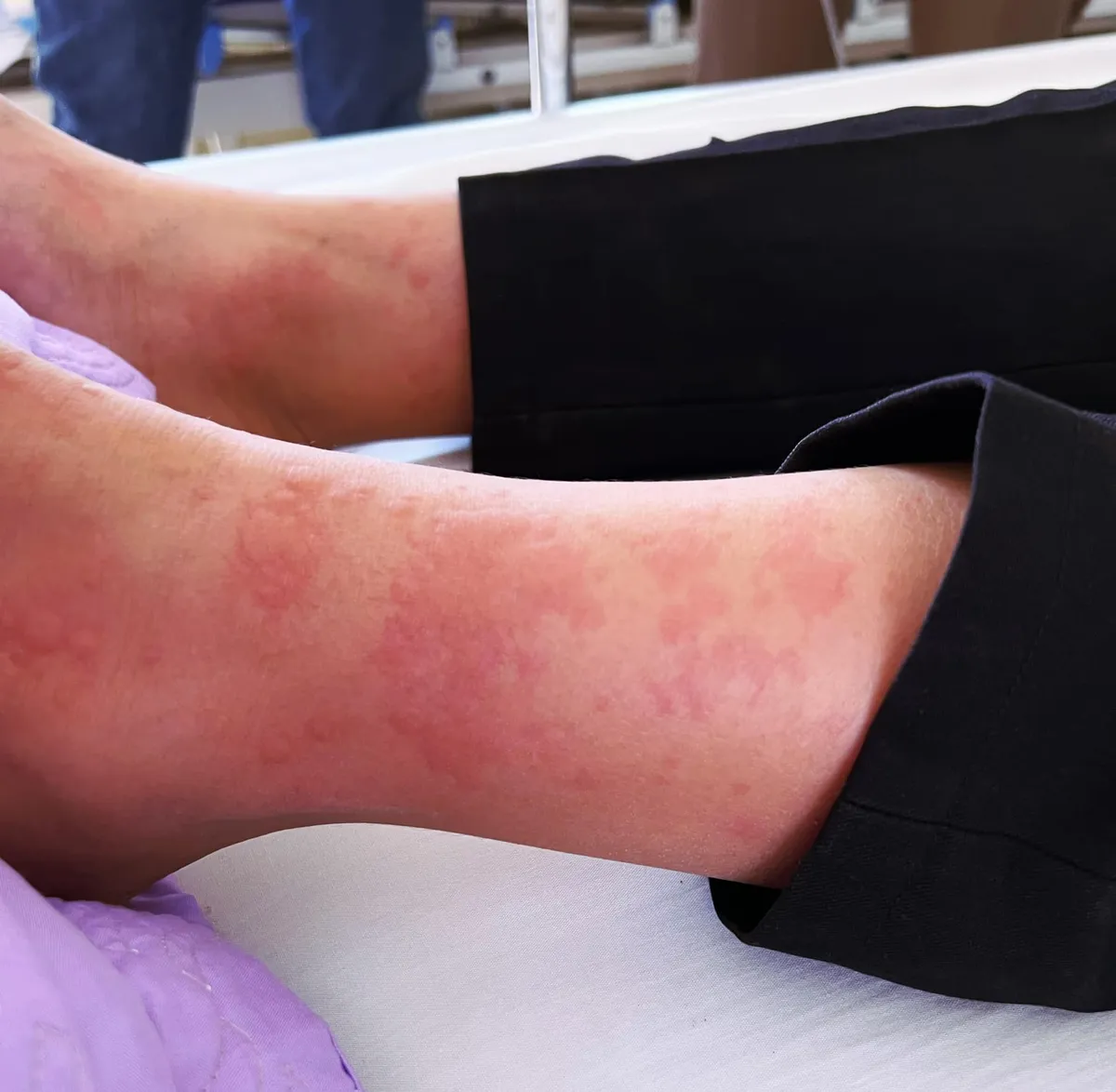 Bé 12 tuổi sốc phản vệ nguy kịch do ong mặt quỷ đốt - Ảnh 1.