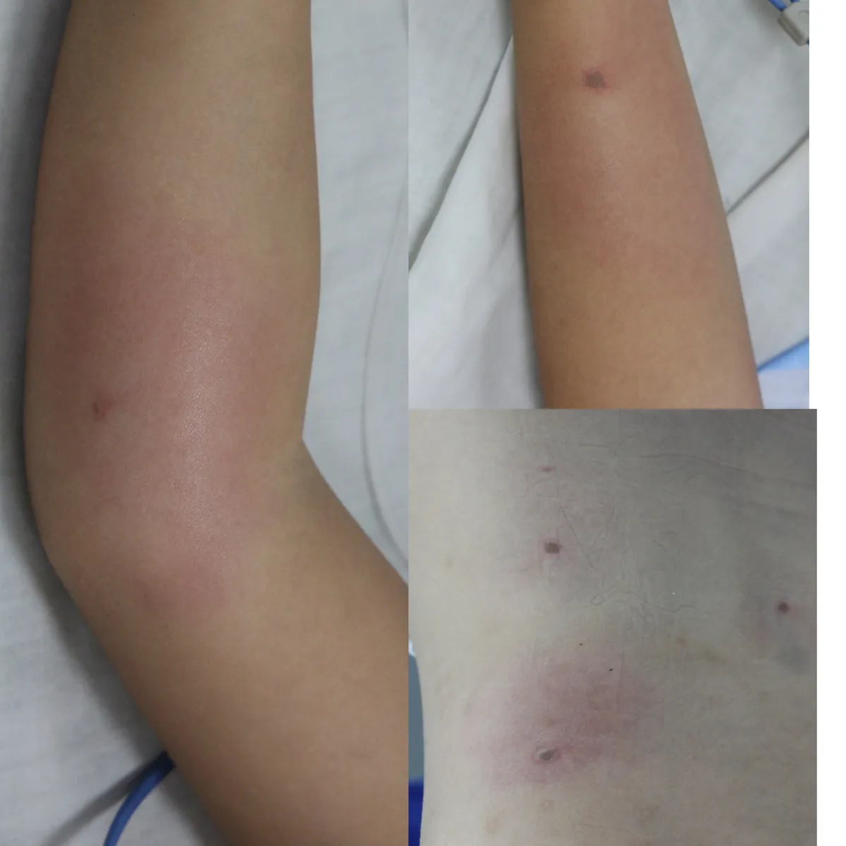 Tổ ong vò vẽ rơi trúng đầu, bé gái bị ong đốt nguy kịch - Ảnh 1.