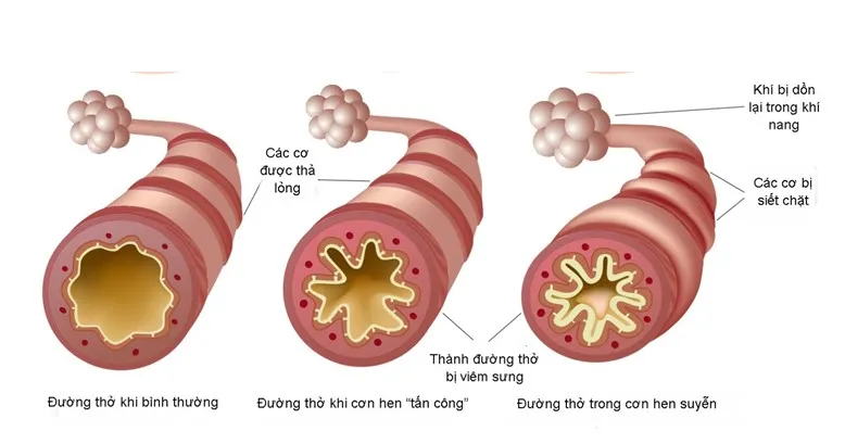 Giải pháp cải thiện ho, khò khè, khó thở - Ảnh 1. Giải pháp cải thiện ho, khò khè, khó thở - Ảnh 1.