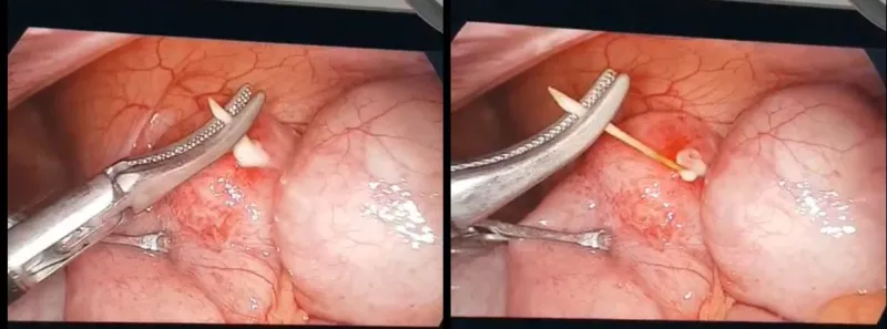 Bé trai 8 tuổi bị thủng ruột non do nuốt phải tăm tre - Ảnh 1. Bé trai 8 tuổi bị thủng ruột non do nuốt phải tăm tre - Ảnh 1.