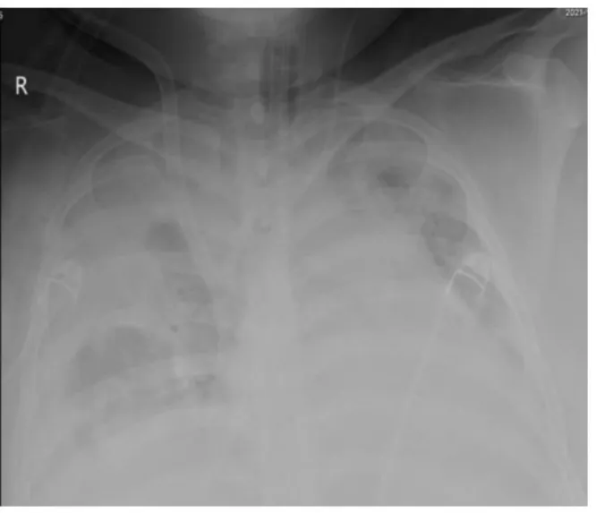 84 ngày can thiệp ECMO cứu bệnh nhân COVID-19 nguy kịch - Ảnh 1.