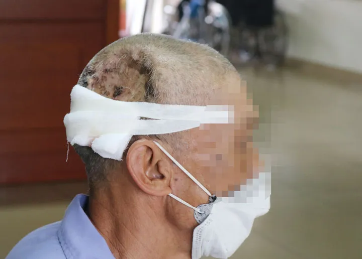 Người đ&agrave;n &ocirc;ng nhập viện với tấm Titanium hở tr&ecirc;n sọ n&atilde;o - Ảnh 1.