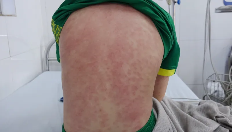 Quảng Ninh: Hai trẻ phải nhập viện do mắc hội chứng viêm đa hệ thống hậu COVID-19 - Ảnh 1. Quảng Ninh: Hai trẻ phải nhập viện do mắc hội chứng viêm đa hệ thống hậu COVID-19 - Ảnh 1.