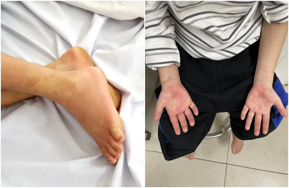 Bệnh nhi 12 tuổi bị viêm cơ tim nguy kịch do hội chứng viêm đa hệ thống hậu COVID-19 - Ảnh 1. Bệnh nhi 12 tuổi bị viêm cơ tim nguy kịch do hội chứng viêm đa hệ thống hậu COVID-19 - Ảnh 1.