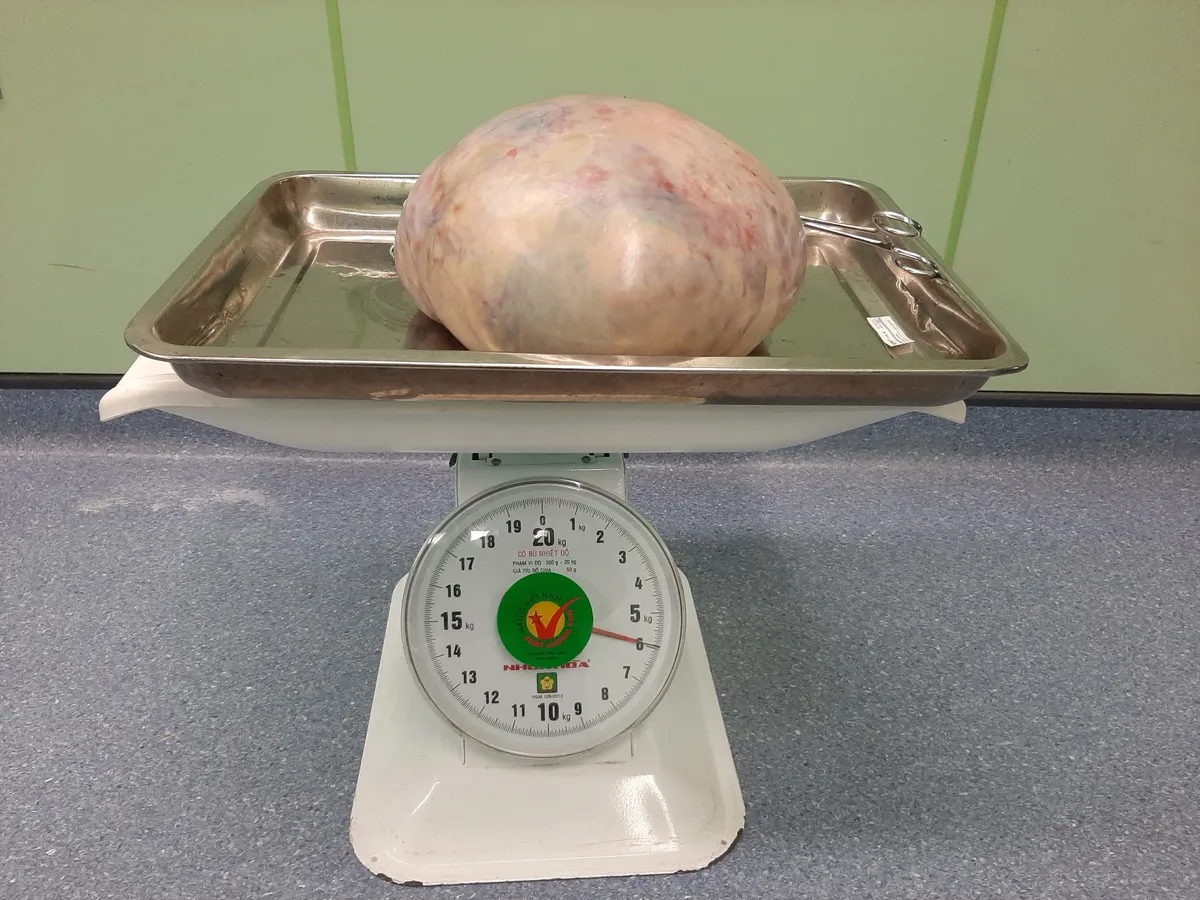 Cắt bỏ khối u nang buồng trứng nặng gần 6kg cho nữ bệnh nhân - Ảnh 1. Cắt bỏ khối u nang buồng trứng nặng gần 6kg cho nữ bệnh nhân - Ảnh 1.
